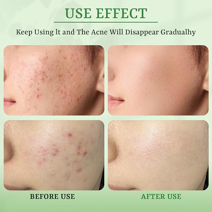 Anti Acne Face Mask Salicylic Acid Face Masks Skincare, Hydrating Face Masks, Soothing Facial Sheet Mask Skin Care for Acne Prone, Acne Mask for Pimple Breakouts Oil Control, 10 Pack